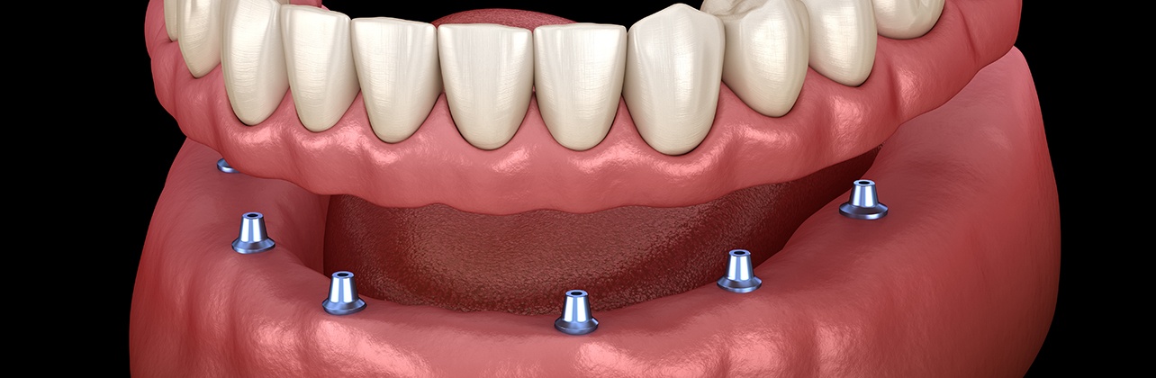 Implant dentures combine the security of dental implants with the natural looking appearance of dentures.