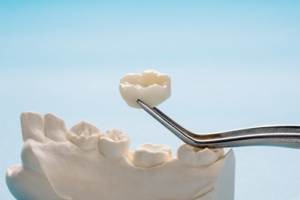 A close up of a dental crown with a wax model of teeth in the background